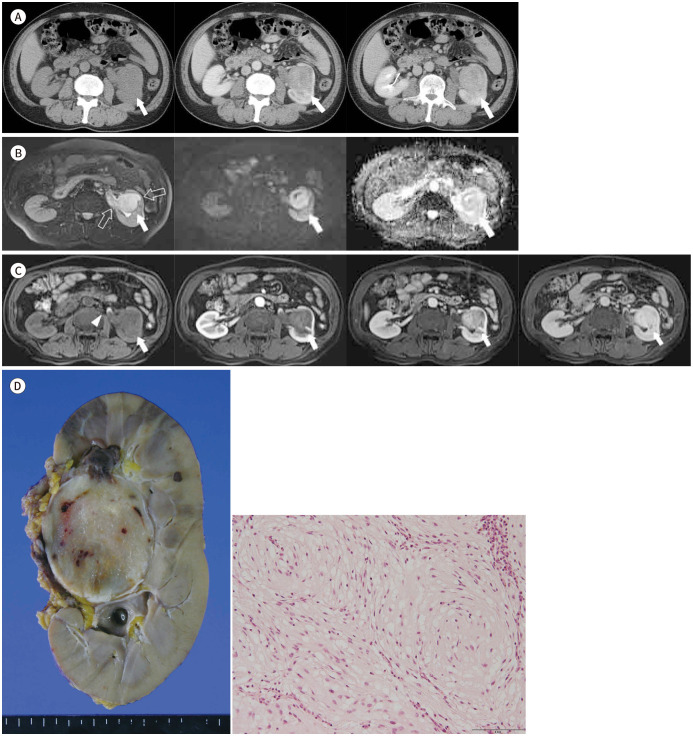 MRI Findings of Renal Myxoma: A Case Report and Literature Review.