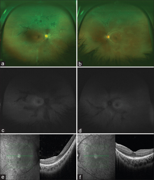 Intermediate Uveitis in Retinitis Pigmentosa Associated with a Novel Homozygous Splice Site Mutation in <i>PRPF8</i>.