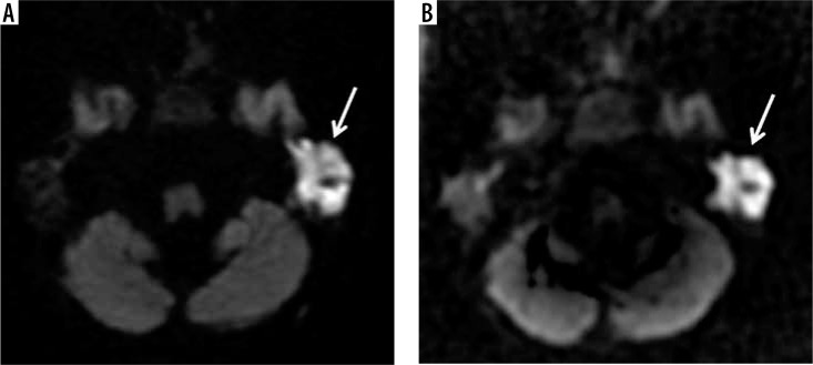 The value of different diffusion-weighted magnetic resonance techniques in the diagnosis of middle ear cholesteatoma. Is there still an indication for echo-planar diffusion-weighted imaging?