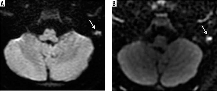 The value of different diffusion-weighted magnetic resonance techniques in the diagnosis of middle ear cholesteatoma. Is there still an indication for echo-planar diffusion-weighted imaging?