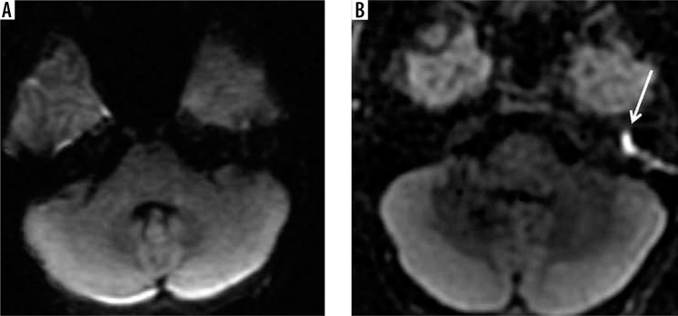 The value of different diffusion-weighted magnetic resonance techniques in the diagnosis of middle ear cholesteatoma. Is there still an indication for echo-planar diffusion-weighted imaging?