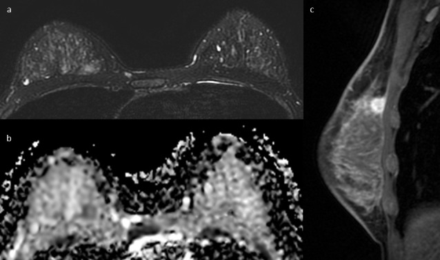 MRI as a biomarker for breast cancer diagnosis and prognosis.