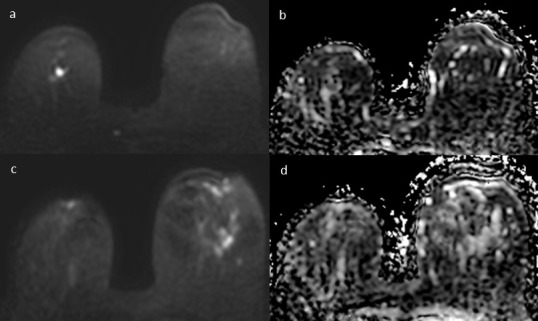 MRI as a biomarker for breast cancer diagnosis and prognosis.