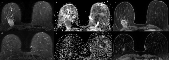 MRI as a biomarker for breast cancer diagnosis and prognosis.