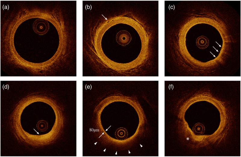 Impact of prediabetes and duration of diabetes on radial artery atherosclerosis in acute coronary syndrome patients: An optical coherence tomography study.