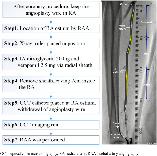 Impact of prediabetes and duration of diabetes on radial artery atherosclerosis in acute coronary syndrome patients: An optical coherence tomography study.