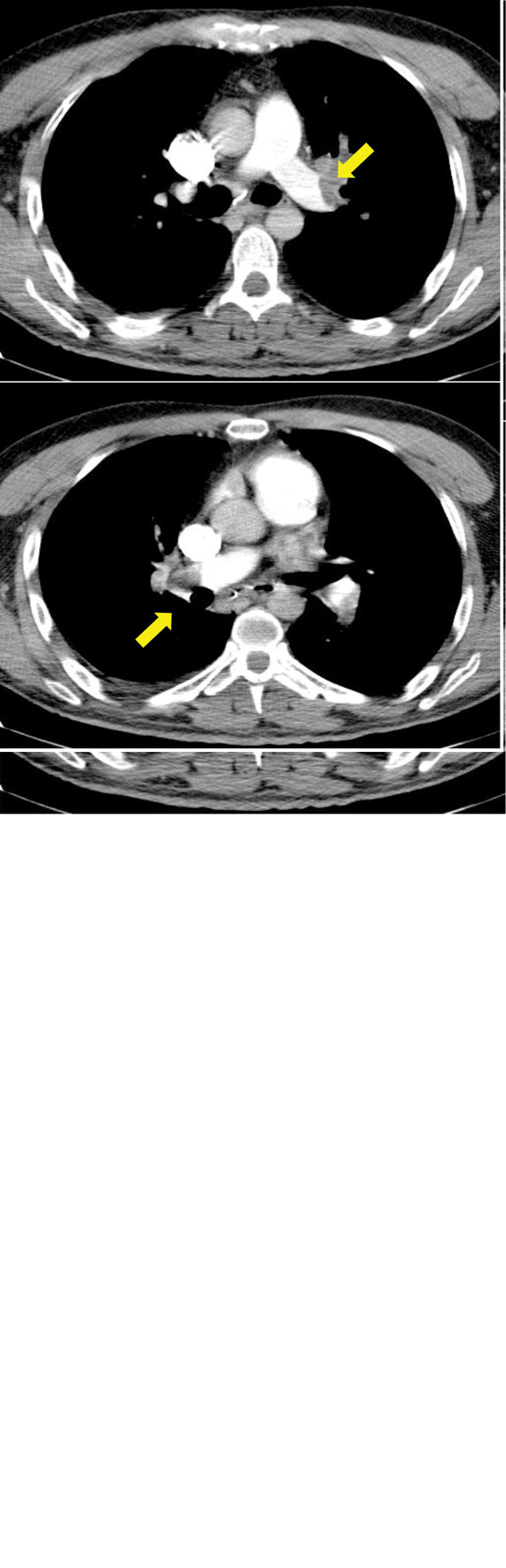 A rare presentation of pulmonary thromboembolism as seizure.