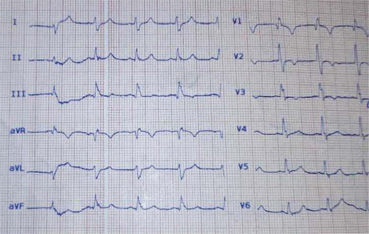 A rare presentation of pulmonary thromboembolism as seizure.