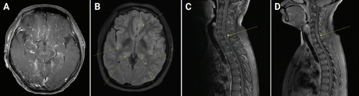 Clinical significance of Epstein-Barr virus polymerase chain reaction in cerebrospinal fluid.
