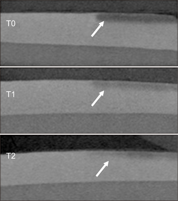 Micro-computed tomographic evaluation of the effect of fluoride agents on white spot lesions: An <i>in vitro</i> study.