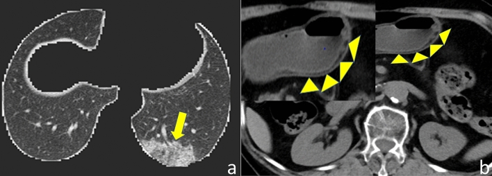 The correlation between COVID-19 segmentation volume based on artificial intelligence technology and gastric wall edema: a multi-center study in Wuhan.