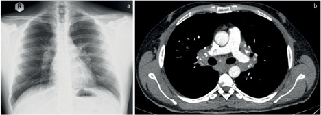 A case of nail sarcoidosis with rich clinical findings.