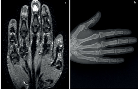 A case of nail sarcoidosis with rich clinical findings.