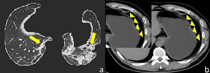 The correlation between COVID-19 segmentation volume based on artificial intelligence technology and gastric wall edema: a multi-center study in Wuhan.