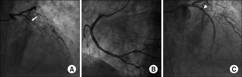 Unusual Case of Interventricular Septal Dissection with Defects Following Anterior Myocardial Infarction.