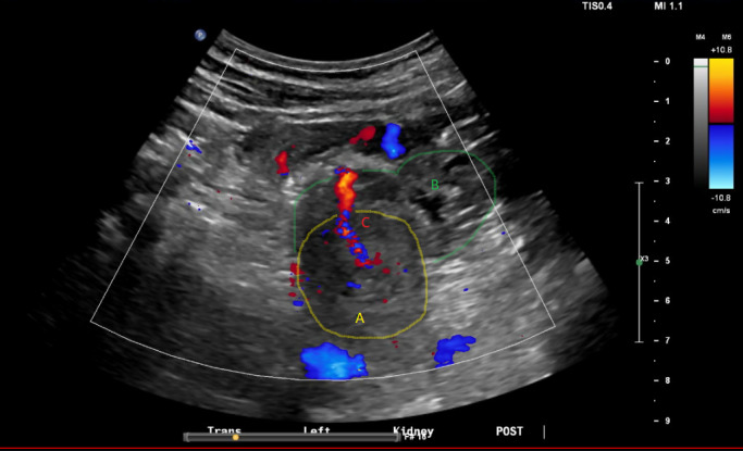 Point of Care Ultrasound in Monitoring of Post-Renal Biopsy Bleeding.