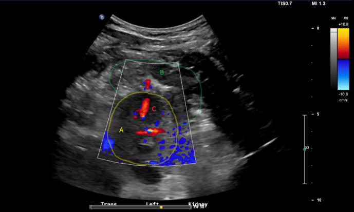 Point of Care Ultrasound in Monitoring of Post-Renal Biopsy Bleeding.