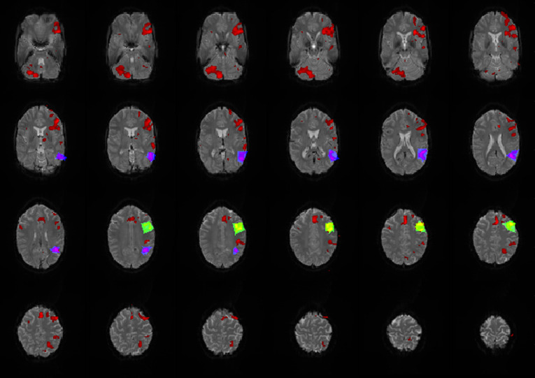 Improved localization of language areas using single voxel signal analysis of unprocessed fMRI data.