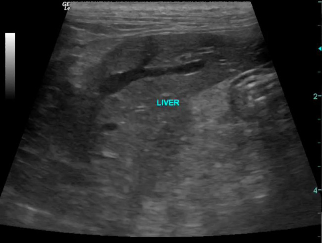 A mediastinal mass causing Budd-Chiari-like syndrome in a cat.