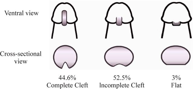 Hypospadias in toddlers: a multivariable study of prognostic factors in distal to mid-shaft hypospadias and review of literature.