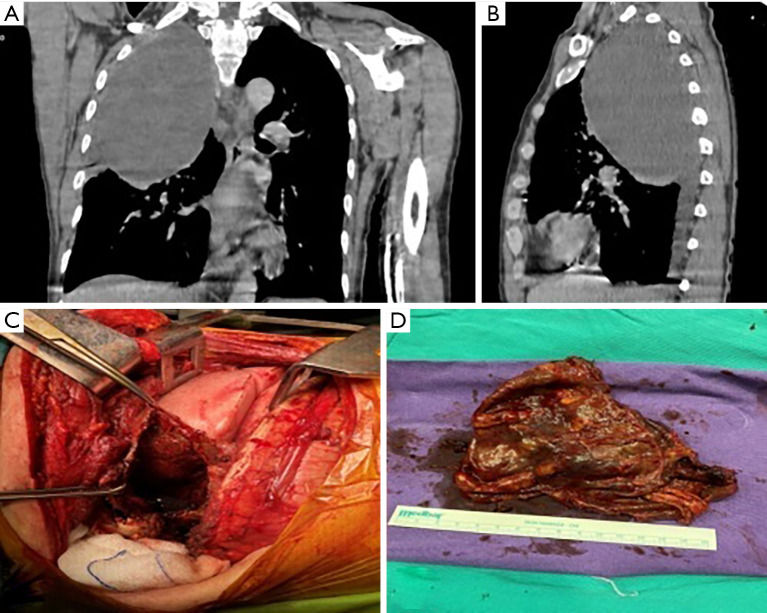 Giant tumors of the posterior mediastinum: a narrative review of surgical treatment.