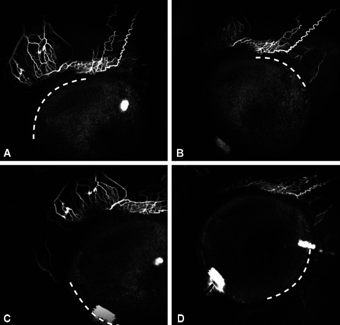 Aqueous Angiography-guided Minimally Invasive Glaucoma Surgery.