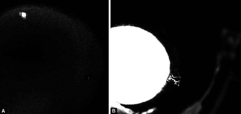 Aqueous Angiography-guided Minimally Invasive Glaucoma Surgery.