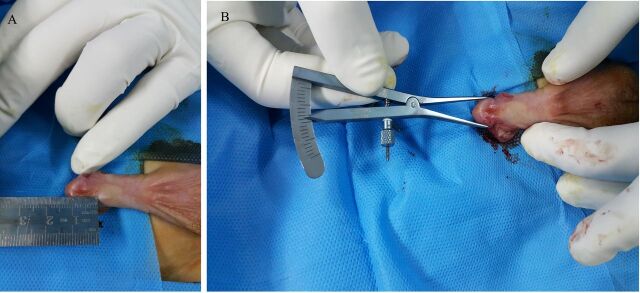 Hypospadias in toddlers: a multivariable study of prognostic factors in distal to mid-shaft hypospadias and review of literature.