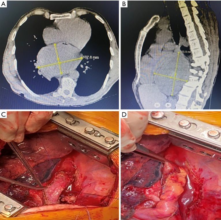 Giant tumors of the posterior mediastinum: a narrative review of surgical treatment.