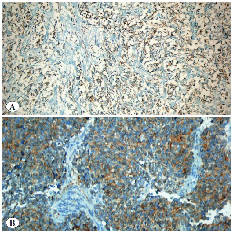 Role of Immunohistochemistry in the Differential Diagnosis of Pediatric Renal Tumors: Expression of Cyclin D1, Beta-Catenin , PDGFR-Alpha, and PTEN.