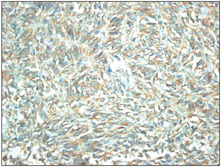 Role of Immunohistochemistry in the Differential Diagnosis of Pediatric Renal Tumors: Expression of Cyclin D1, Beta-Catenin , PDGFR-Alpha, and PTEN.