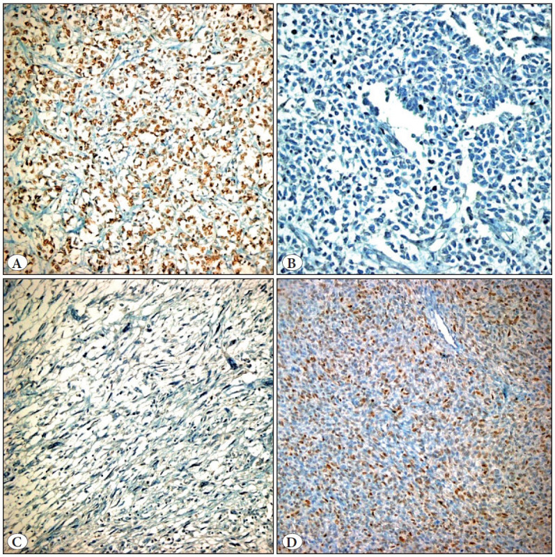 Role of Immunohistochemistry in the Differential Diagnosis of Pediatric Renal Tumors: Expression of Cyclin D1, Beta-Catenin , PDGFR-Alpha, and PTEN.