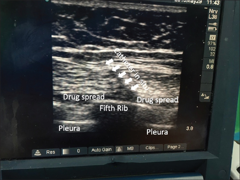 Ultrasound-guided Serratus Anterior Plane Block for Accelerated Partial Breast Irradiation using Multi-catheter Interstitial Brachytherapy Technique under Anesthesia in Breast Cancer Patients: A Case Series.