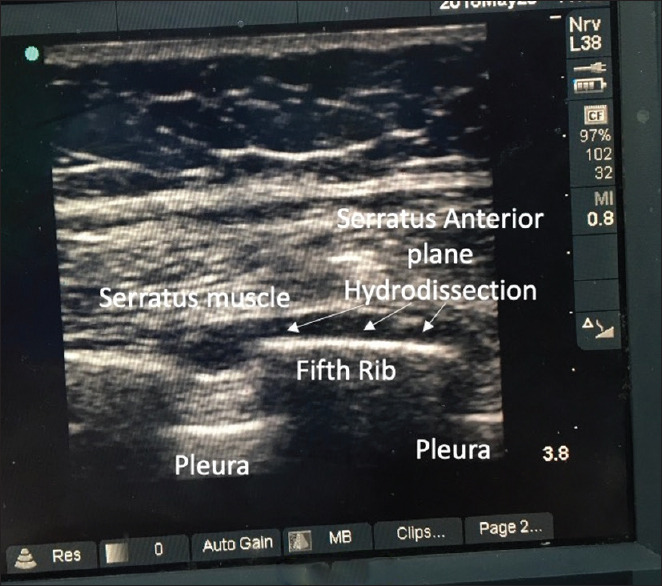 Ultrasound-guided Serratus Anterior Plane Block for Accelerated Partial Breast Irradiation using Multi-catheter Interstitial Brachytherapy Technique under Anesthesia in Breast Cancer Patients: A Case Series.