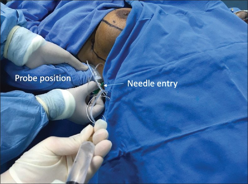 Ultrasound-guided Serratus Anterior Plane Block for Accelerated Partial Breast Irradiation using Multi-catheter Interstitial Brachytherapy Technique under Anesthesia in Breast Cancer Patients: A Case Series.