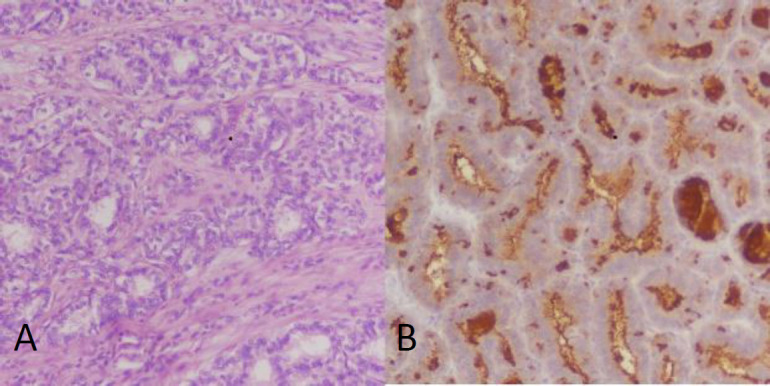 A case report of differentiated thyroid cancer presenting as a renal mass.