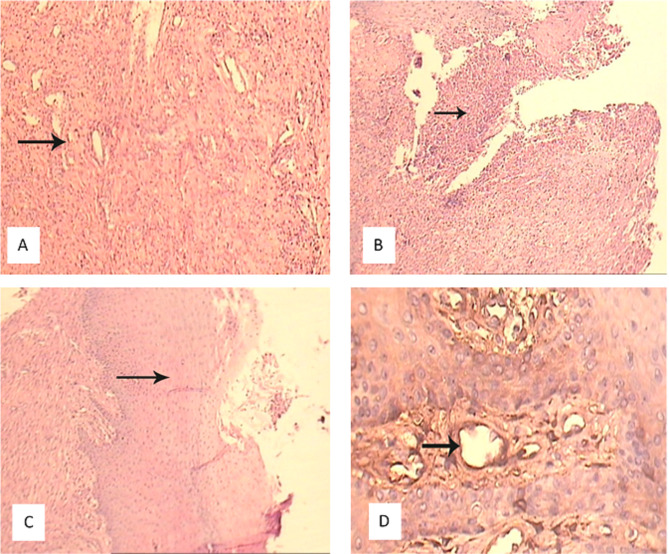 Effect of leukocyte and platelet-rich fibrin on free gingival graft healing: A clinical and histological study in rabbits.