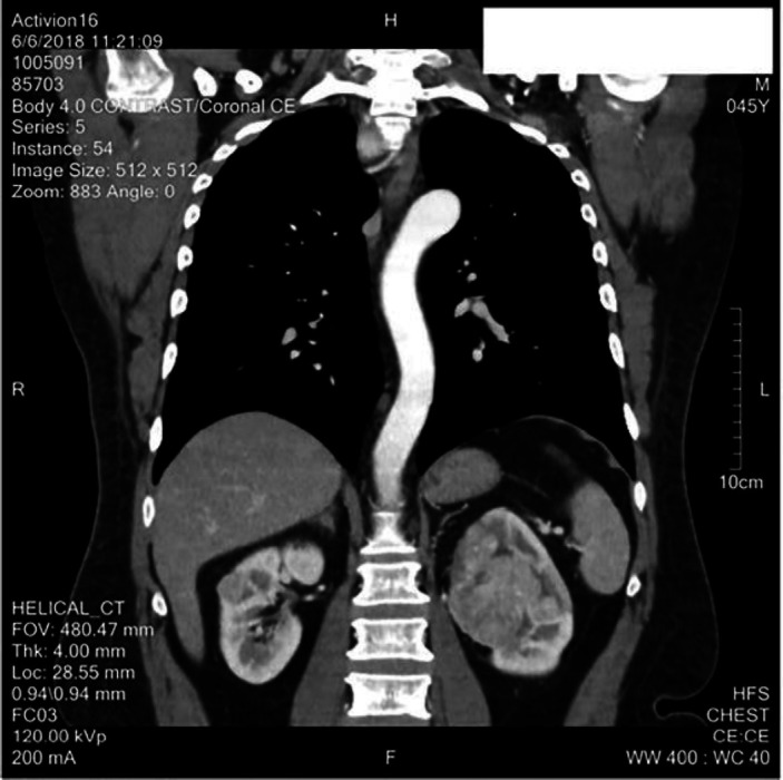 A case report of differentiated thyroid cancer presenting as a renal mass.