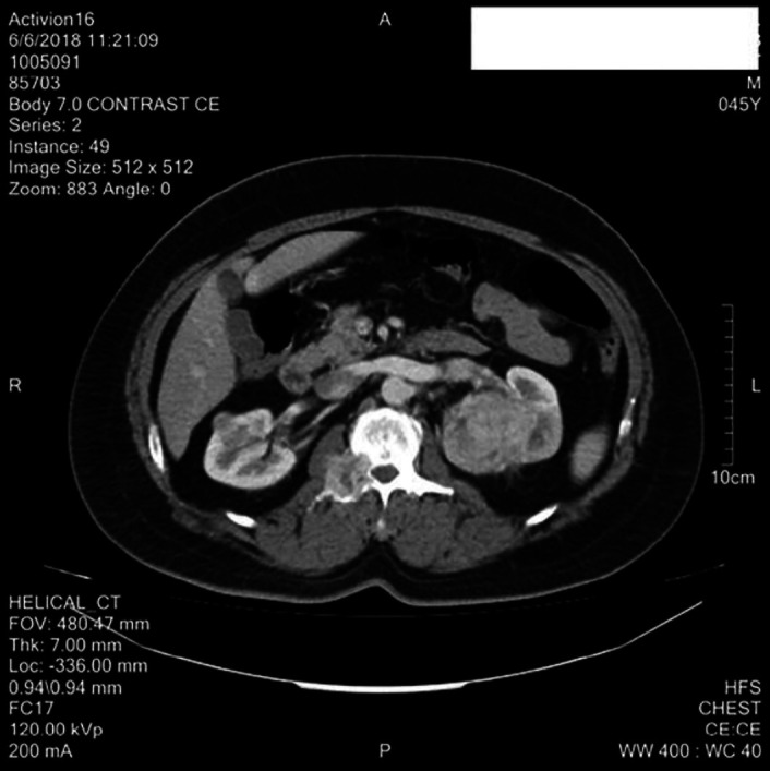 A case report of differentiated thyroid cancer presenting as a renal mass.