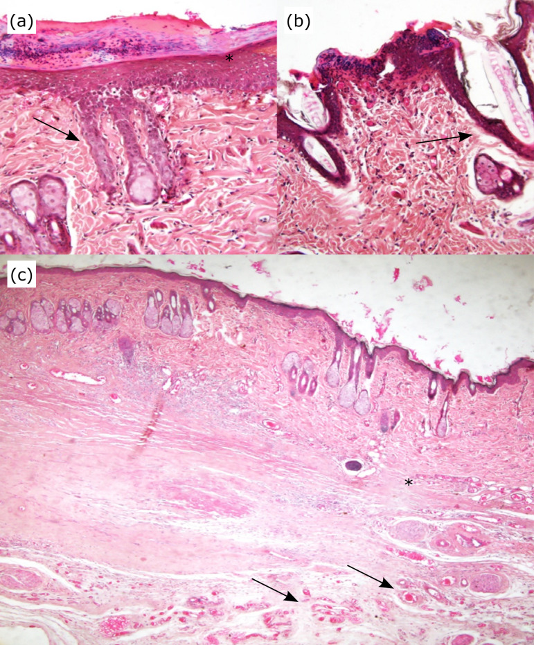 Skin graft associated with platelet-rich plasma in correcting extensive injuries resulting from the resection of skin cancer chemically induced in rats.