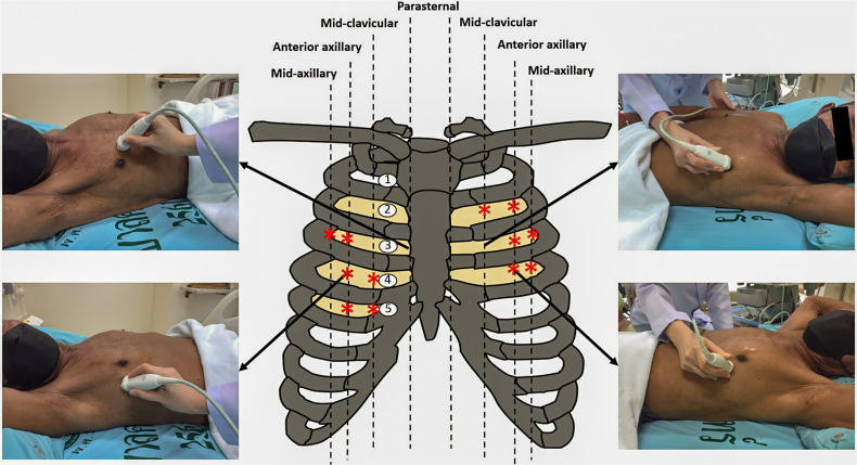 Lung Ultrasound Estimates the Overhydration and Benefits Blood Pressure Control in Normal or Mild Symptomatic Hemodialysis Patients.