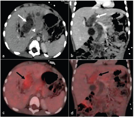 Embryonal Rhabdomyosarcoma of the Biliary Tree as a Differential in a Paediatric Patient Presenting with Biliary Dilatation: Not Always a Choledochal Cyst.