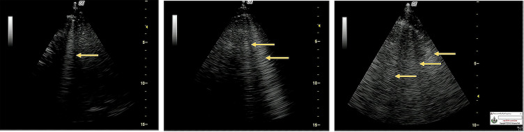 Lung Ultrasound Estimates the Overhydration and Benefits Blood Pressure Control in Normal or Mild Symptomatic Hemodialysis Patients.