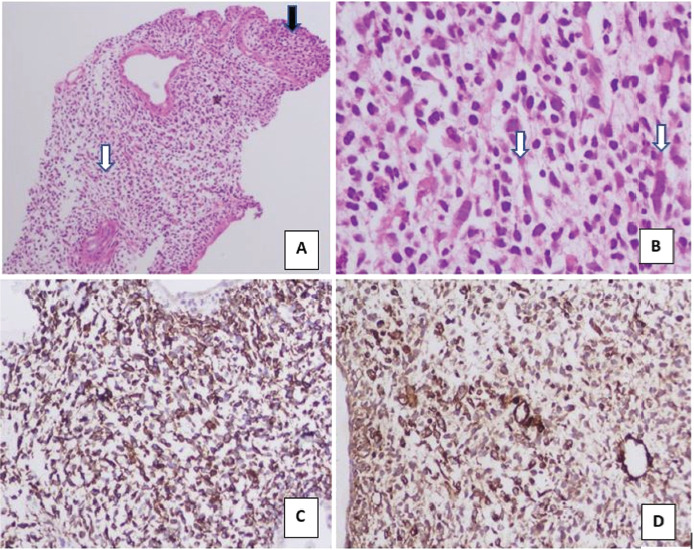 Embryonal Rhabdomyosarcoma of the Biliary Tree as a Differential in a Paediatric Patient Presenting with Biliary Dilatation: Not Always a Choledochal Cyst.