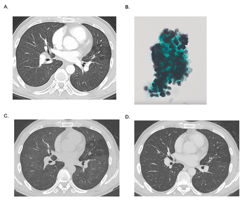 A case of <i>Pneumocystis jirovecii</i> pneumonia in a patient with acquired immune deficiency syndrome who showed eosinophilia and an increased serum TARC/CCL17 level.