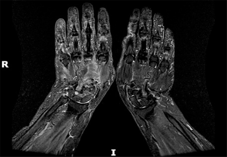 Paraneoplastic arthritides: an up-to-date case-based systematic review.