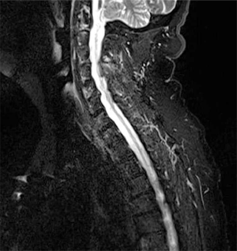 Paraneoplastic arthritides: an up-to-date case-based systematic review.