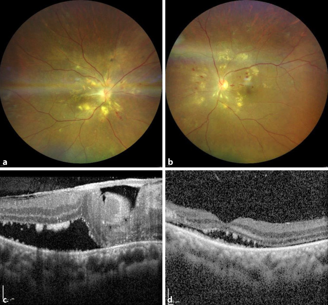 [Bilateral serous retinal detachment: possible complication of parvovirus infection?]
