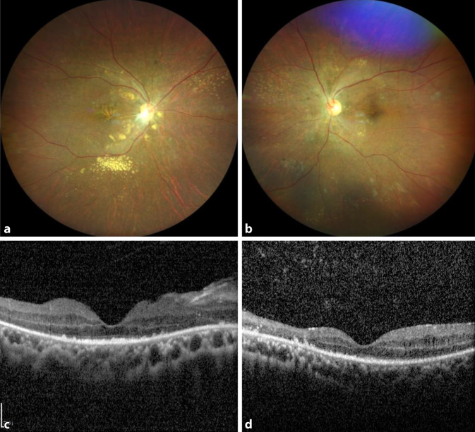 [Bilateral serous retinal detachment: possible complication of parvovirus infection?]