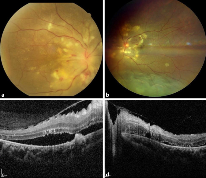 [Bilateral serous retinal detachment: possible complication of parvovirus infection?]